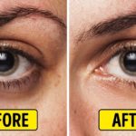 home remedies for dark circles