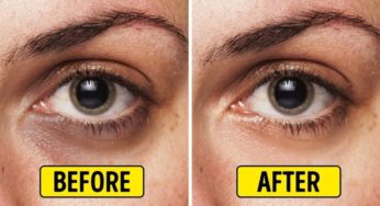 How To Remove Dark Circles Permanently At Home [Effective Remedies]