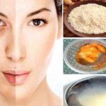 home remedis for pigmentation