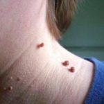 facts about skin tags