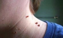 facts about skin tags