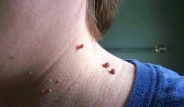 facts about skin tags