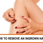 how to remove an ingrown hair