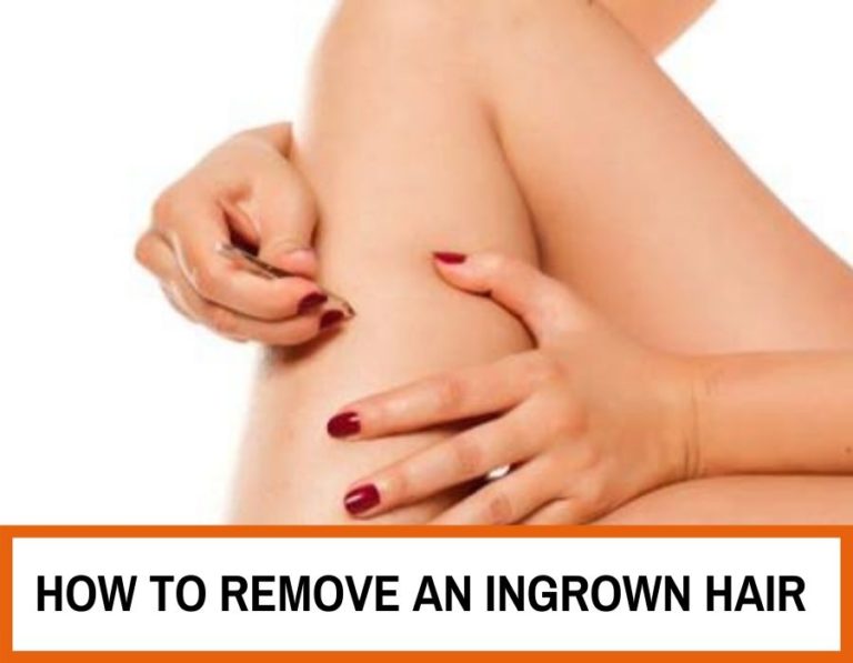 how to remove an ingrown hair