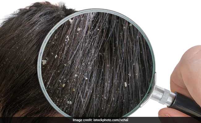 Apple cider vinegar for dandruff