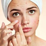 reduce the appearance of acne scarring