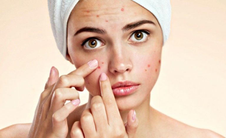 reduce the appearance of acne scarring