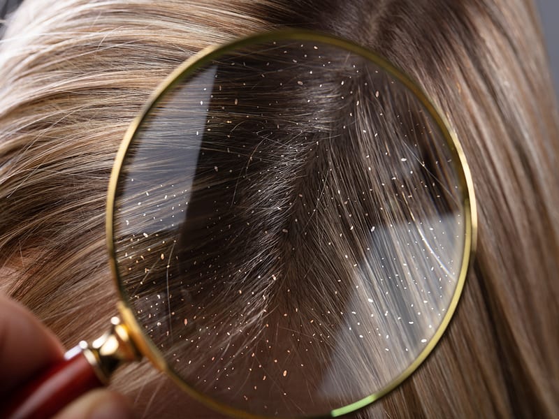 get-rid-of-dandruff