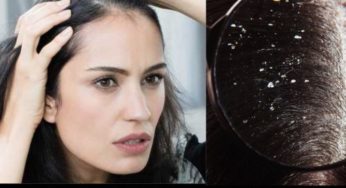 How To Get Rid of Dandruff Fast Permanetaly At Home