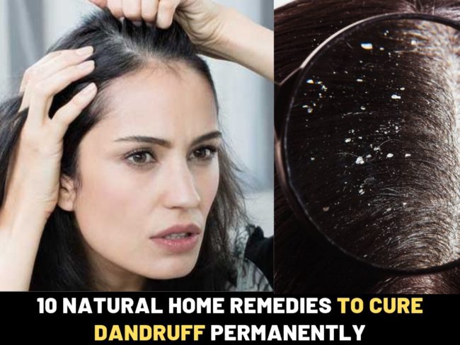 Get-rid-of-dandruff