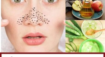 How To Remove Blackheads At Home Permanently