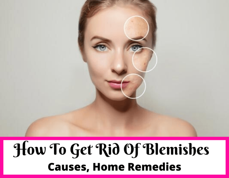 How To Get Rid Of Blemishes At Home [Home Remedies]