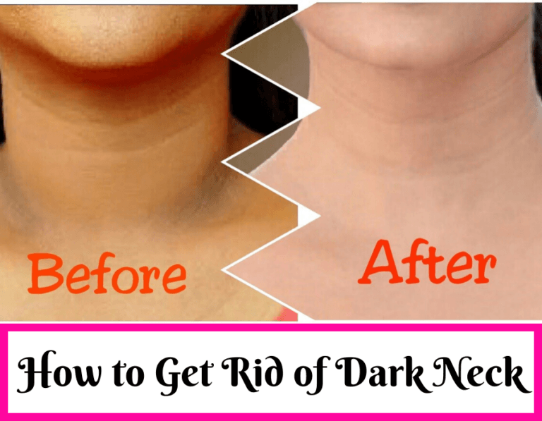 How to Get Rid of Dark Neck: 13 Natural Home Remedies