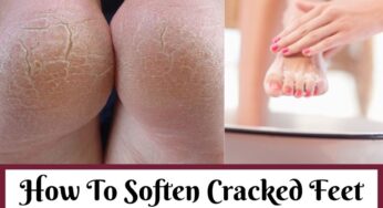 How To Heal Cracked Feet Overnight In Winter?