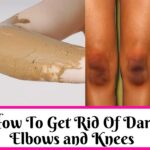 Get Rid Of Dark Elbows and Knees
