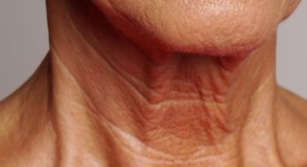 Neck Wrinkles: Causes and Ways to Prevent them