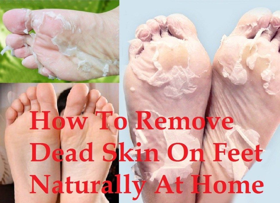 Home Remedies to Remove Dead Skin from Feet- Trabeauli