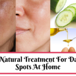 Best Treatment For Dark Spots