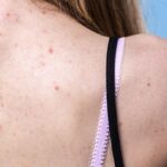 get rid of back acne