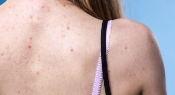 How to Get Rid of Back Acne at Home