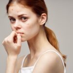 How to Remove Pimples Overnight