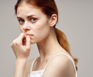 How to Remove Pimples Overnight