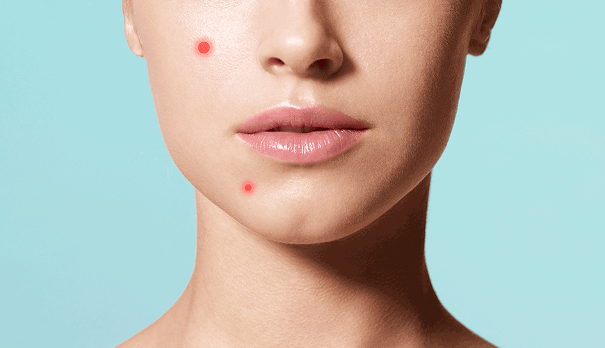 pimples causes
