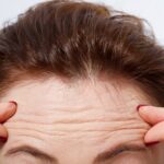 getting-rid-of-forehead-wrinkles