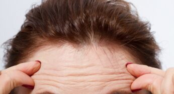 Getting Rid of Forehead Wrinkles With Natural Remedies