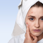 get-rid-of-pimples