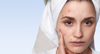 How To Get Rid of Pimples Fast At Home