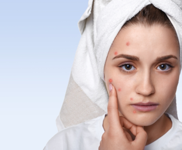 get-rid-of-pimples