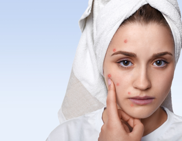 get-rid-of-pimples