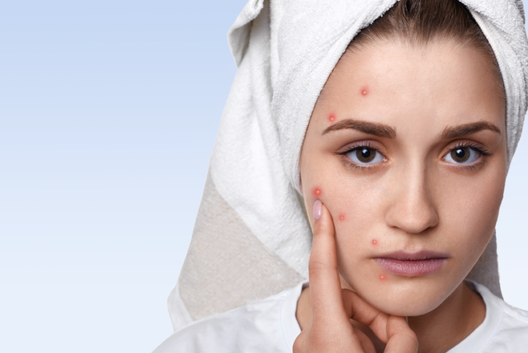 get-rid-of-pimples