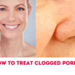 How To Treat Clogged Pores?