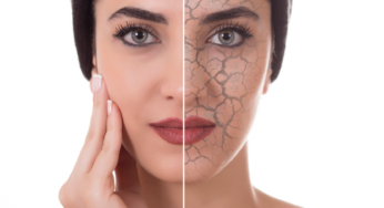 How to Treat Dry Skin on Face?