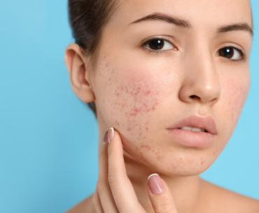 Pimple Scars Treatment at Home