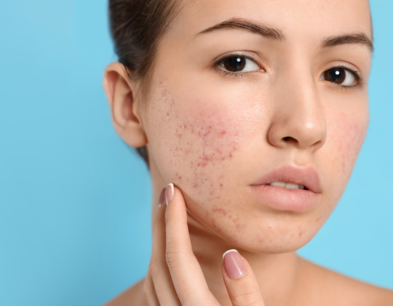 Pimple Scars Treatment at Home