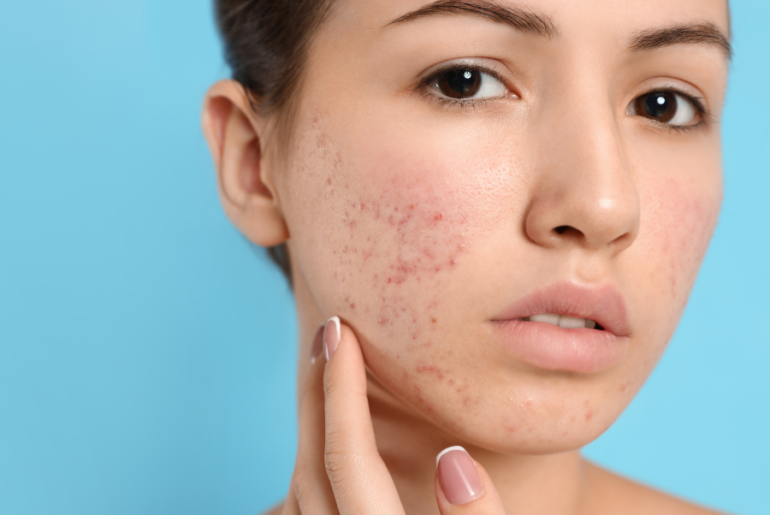 Pimple Scars Treatment at Home