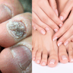 Natural Nail Fungus Treatment