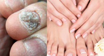 This Natural Nail Fungus Treatment Is Going Viral—And It’s 100% Chemical-Free!