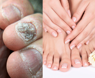 Natural Nail Fungus Treatment