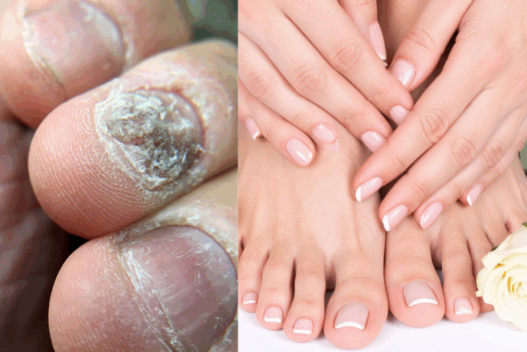 Natural Nail Fungus Treatment