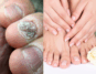 Natural Nail Fungus Treatment