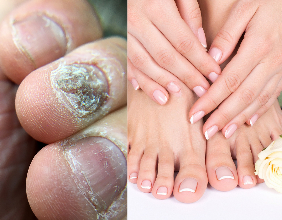 Natural Nail Fungus Treatment