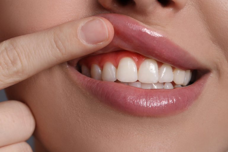Natural Ways to Improve Gum Health